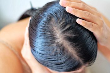 Chăm sóc da đầu nhờn như thế nào?